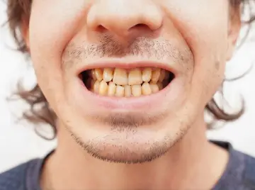 Is Tooth Discoloration Normal? Understanding Loss of Whiteness